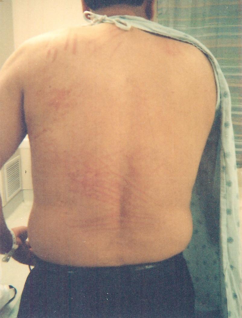 estas son golpes resividos por una mujer celosa, quien mando al esposo al hospital, esta victima estuvo apunto de morir, ya que su estomago se paralizo, por los golpes resividos